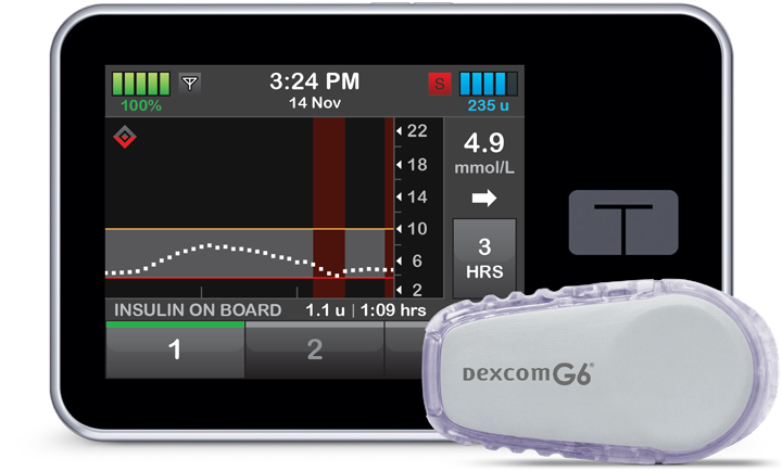 insulin_pump_tslimx2_wbasal-iq_wdexcom_sensor569a5f9775426a79a.png